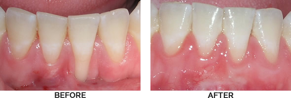 Gum Grafting Before and After Images