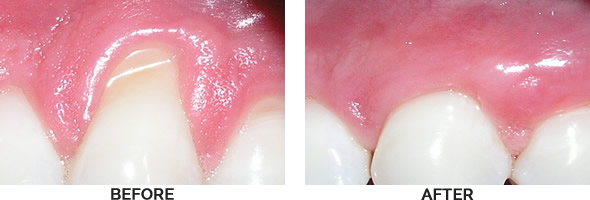 Gum Grafting Before and After Images